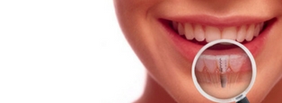 implantes dentales zaragoza