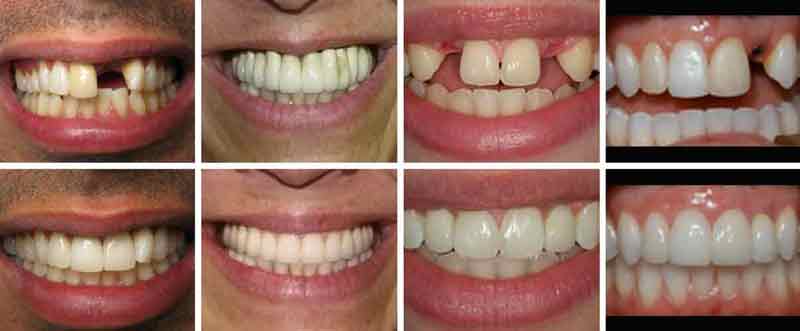 Implantes dentales (antes y después)