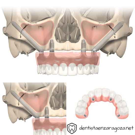 implantes-dentales-cigomaticos