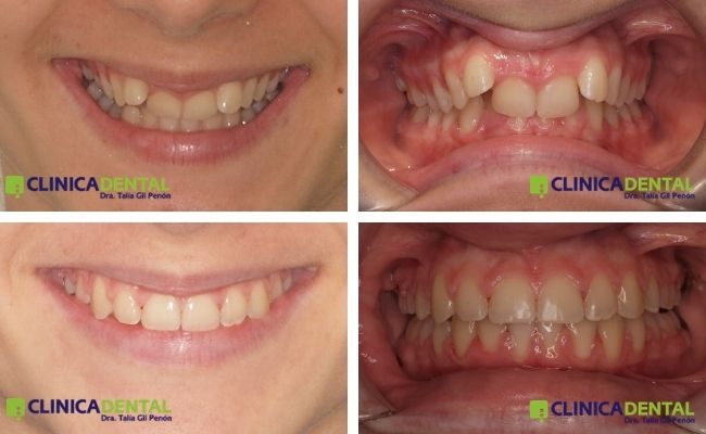 Antes y después del tratamiento con la ortodoncia Damon