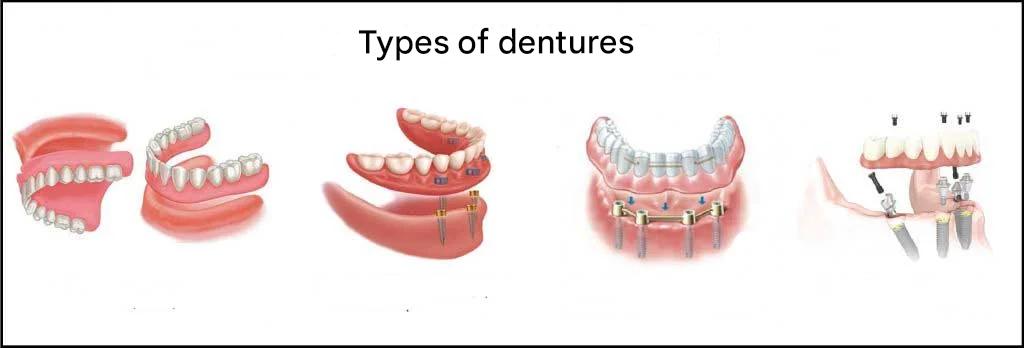 types of prothesis dental