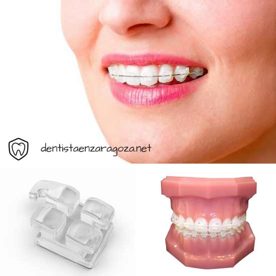 Brackets transparentes