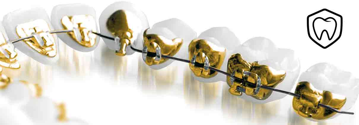 Sublingual Orthodontics in Zaragoza